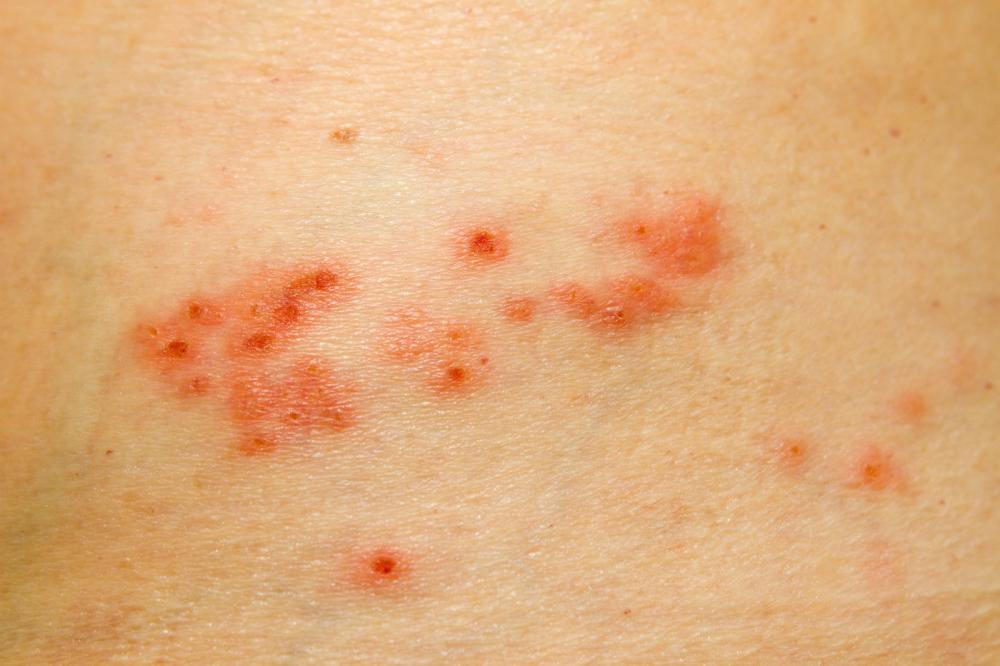 Picture showing new herpes vaccine